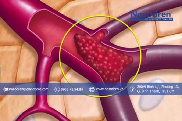 biến chứng viêm xoang ở mạch máu