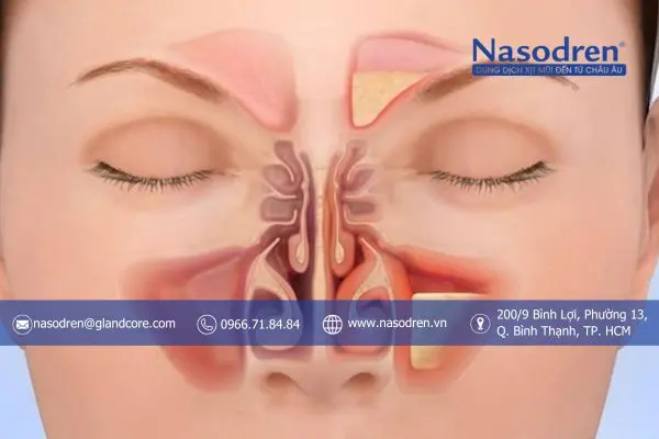 viêm xoang mũi là bệnh lý gì