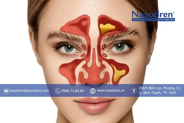 viêm xoang mũi và những điều bạn chưa biết